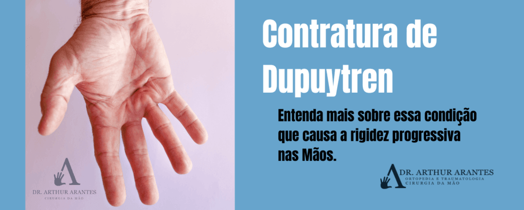 Rigidez em Mãos e Dedos - Contratura de Dupuytren