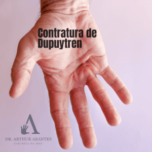 Imagem de uma mão com contratura de Dupuytren, mostrando os sinais típicos da doença, como flexão dos dedos e formação de nódulos na palma. A contratura de Dupuytren é uma condição ortopédica que afeta a fáscia palmar e pode ser tratada com cirurgia. Consultório especializado em cirurgia da mão em Concórdia, SC - Dr. Arthur Arantes