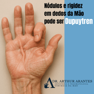 Imagem de uma mão com contratura de Dupuytren, mostrando os sinais típicos da doença, como flexão dos dedos e formação de nódulos na palma. A contratura de Dupuytren é uma condição ortopédica que afeta a fáscia palmar e pode ser tratada com cirurgia. Consultório especializado em cirurgia da mão em Concórdia, SC - Dr. Arthur Arantes