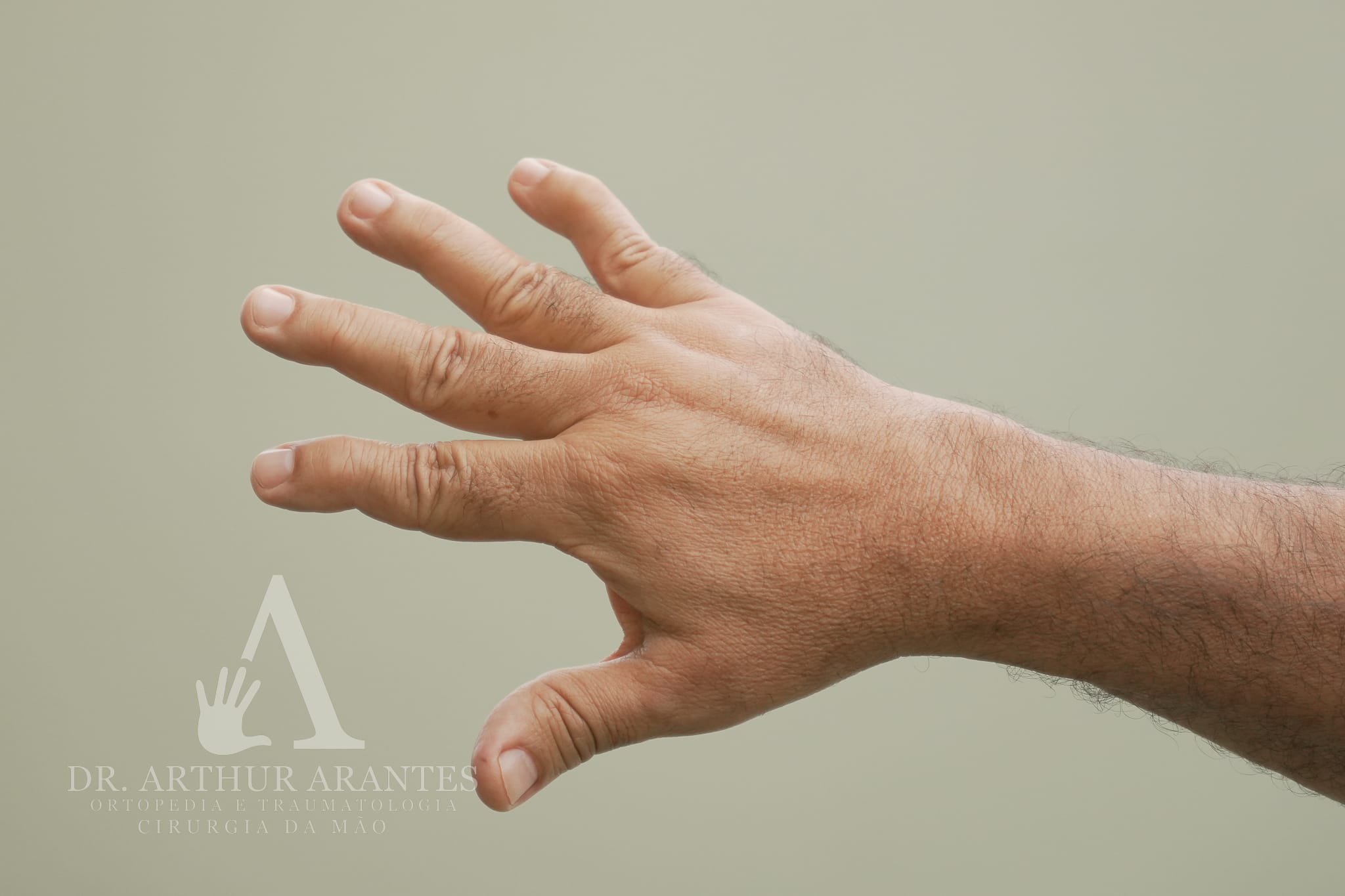 Fraturas da Mão: quando o gesso não basta